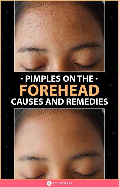 How To Get Rid Of Forehead Acne Causes And Prevention Tips Forehead