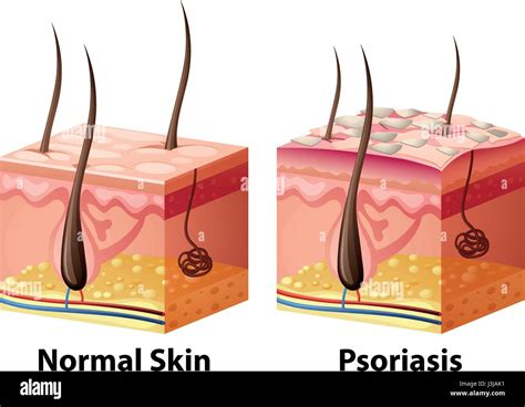 Human Skin Diagram With Normal And Psoriasis Illustration Stock Vector