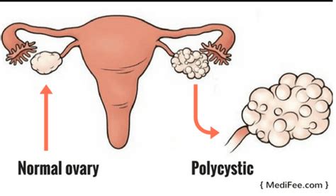 Surgery For Ovarian Cyst Removal Treatments And Risks