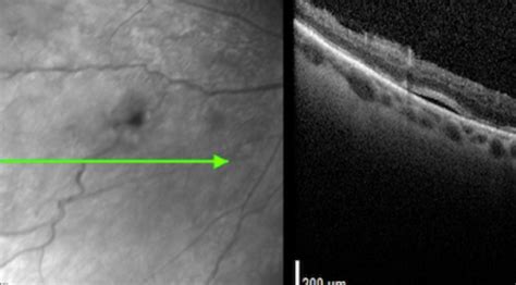 Retinal Imaging In Vitreous Hemorrhage Identification CollaborativeEYE