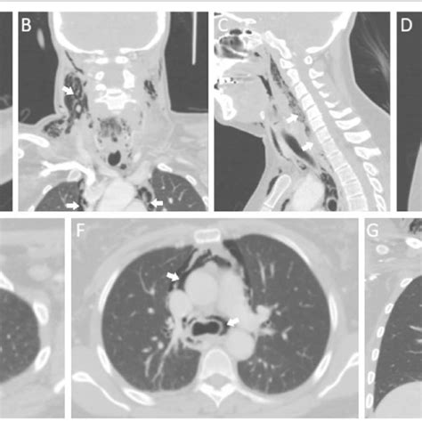 Ct Scan Findings A B Extensive Emphysema In The Soft Tissues Of The