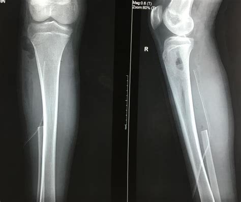 Post Operative Anteroposterior And Lateral Radiographs Showing
