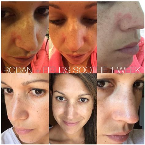 Soothe Worked Miracles In A Week On Nilskas Psoriasis When You Suffer