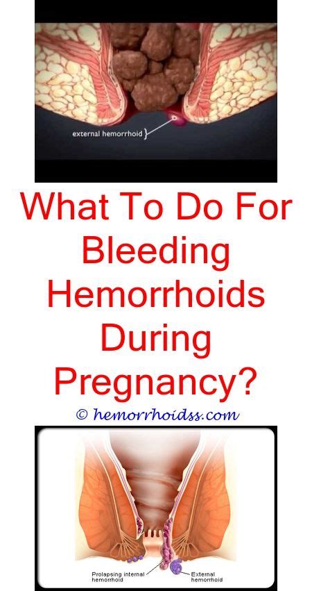 why do hemorrhoids itch so much how to tell if u have a hemorrhoid how witch hazel helps