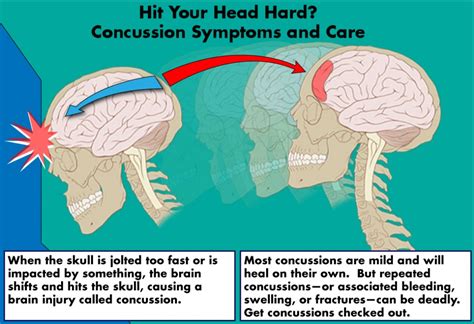 Hit Your Head Hard Concussion Symptoms And Care Healdove