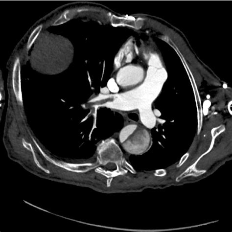Thorax Ct Angiography Showing The Dilatation Of Ascending Aorta Of A