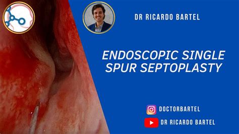 Endoscopic Septoplasty For Single Spur Septal Deviation Youtube