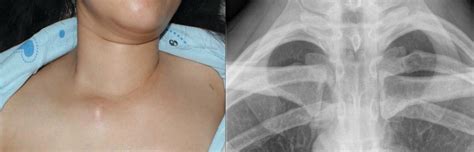 Clavicle Fractures