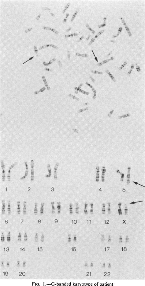 Figure 1 From Duchenne Muscular Dystrophy Dmd In A Female With An X