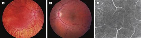 Clinical Appearance Of The Retina A Fundus Photograph Of Patient 3