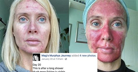 This Womans Graphic Selfies Show Exactly The Danger Tanning Can Do To