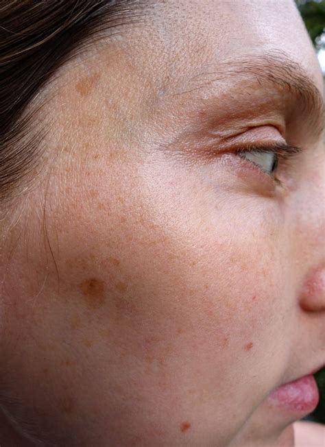 Pin On Skin Care Dark Spots And Melasma