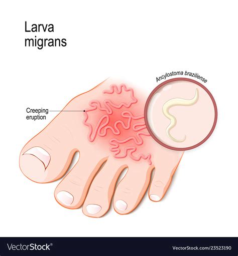 Cutaneous Larva Migrans Skin Disease In Humans Vector Image Human My XXX Hot Girl