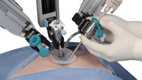 Single Site Robotic Gallbladder Surgery Youtube