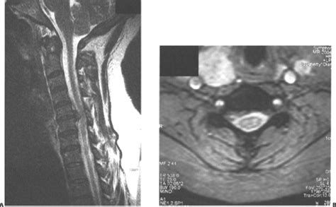 Soft Disk Herniation Anterior Versus Posterior Approaches Neupsy Key