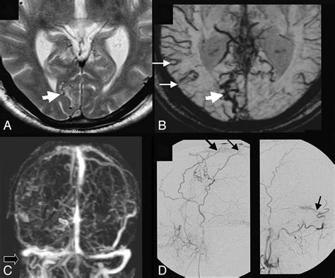 Susceptibility Weighted Imaging In Cranial Dural Arteriovenous Fistulas