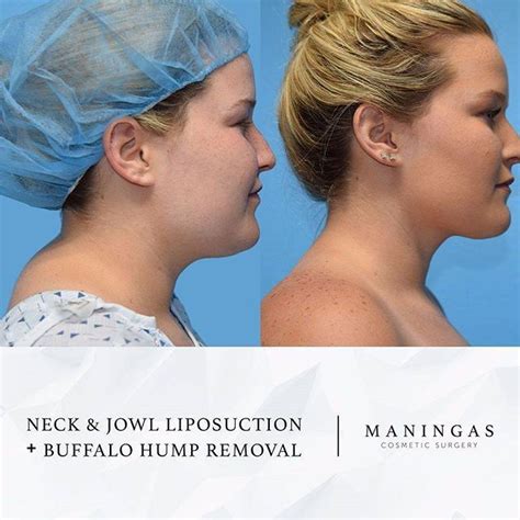 Buffalo hump on the back of the neck can also be exacerbated by the growth of cysts, tumors and other abnormal growths. #transformationtuesday Beautiful results by Dr. Maningas ...