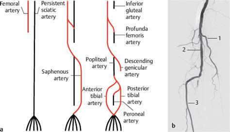 Development Of The Arteries Of The Lower Limb Radiology Key