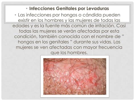 Ppt Candidiasis Genital Tratamiento Cura Real Para Infecciones Por Hongos Recurrentes