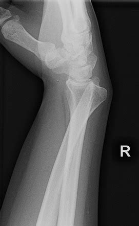 Distal Radioulnar Joint Dislocation Radiology Reference Article Radiopaedia Org
