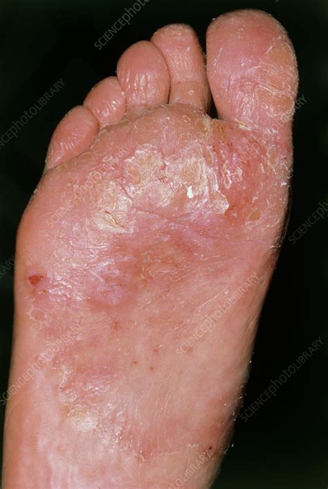 The Sole Of A Foot Affected By Candidiasis Stock Image M1300239