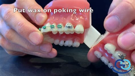 Braces Put Wax On A Poking Orthodontic Wire Youtube