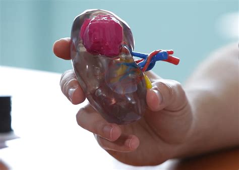 3D printing in kidney cancer treatment - University of ...