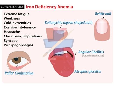 Med Media Plus Iron Deficiency Anemia Clinical Picture