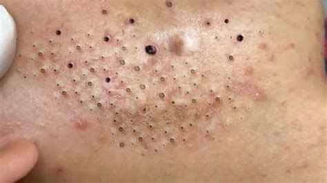 Blackheads And Hidden Acne Near The Neck Youtube