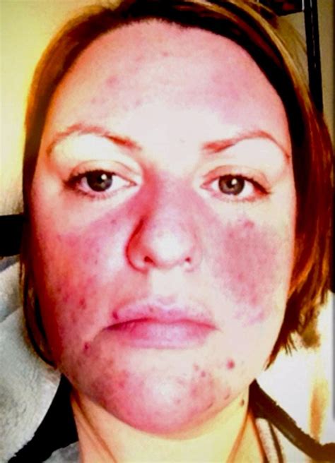 Glasgow Woman Feared Her Face Would Split Open After Hair Dye