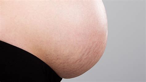 Stretch Marks During And After Pregnancy What To Expect