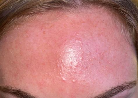 Fungal Acne Supplements Work Rfungalacne