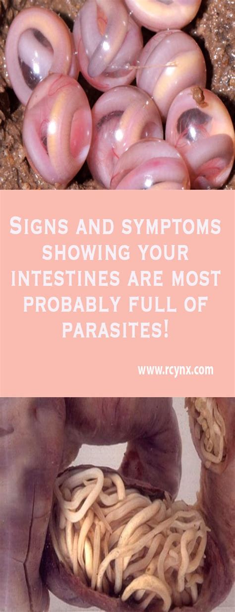Signs And Symptoms Showing Your Intestines Are Most Probably Full Of Parasites