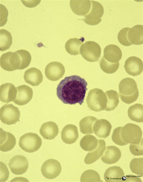 Plasma Cell Vs Lymphocyte