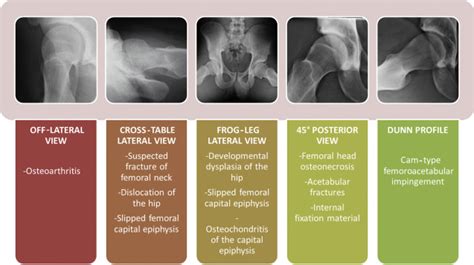 Conventional Radiography Of The Hip Revisited Radiology Key