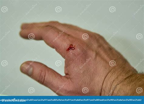 Bleeding Wound Cut Bruise On The Arm Wrist Stock Photo Image Of