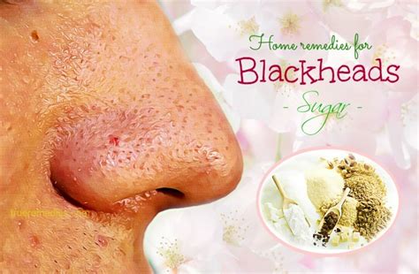 34 Home Remedies For Blackheads On Nose And Face Removal