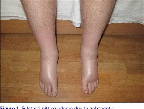 Figure 1 From A Rare Case Of Bilateral Lower Extremity