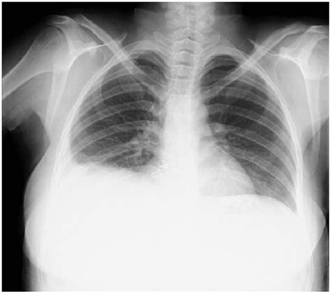 Chest X Ray Showing Right Pleural Effusion In A Patient With Ovarian