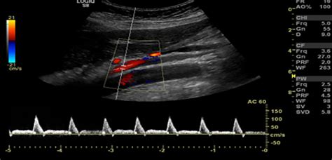 Early Detection Of Superior Mesenteric Artery Dissection By Ultrasound