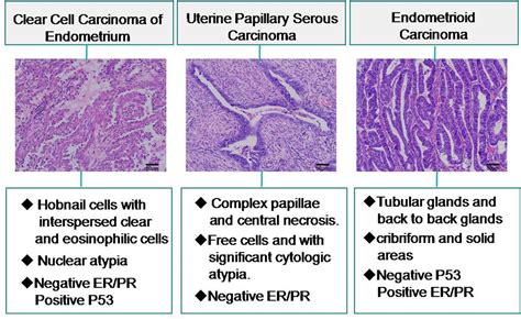 Frontiers Clear Cell Carcinoma Of The Endometrium Evaluation Of Prognostic Parameters In 27 Cases