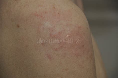 Eczema Pimples On A Shoulder Stock Photo Image Of Problems Skin