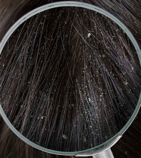 Dandruff There Are 5 Types So You Might Just Be Treating It Wrong