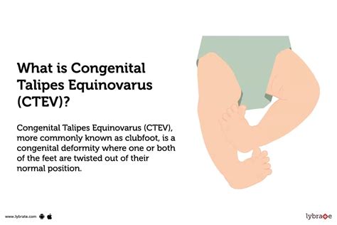 Congenital Talipes Equinovarus Ctev Causes Symptoms Treatment And Cost