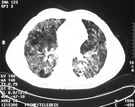 Ct Scan Of The Lungs Axial View Showing Greatly Abnormal Parenchymal