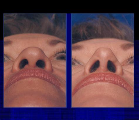 The Nose Clinic Before And After Nose Surgery Photos 10