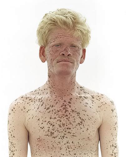 Dravidian Albino People