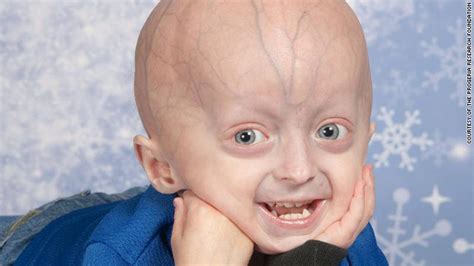 Progeria Hutchinson Gilford Syndrome