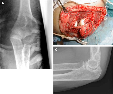 Unstable Elbow Dislocations Journal Of Shoulder And Elbow Surgery