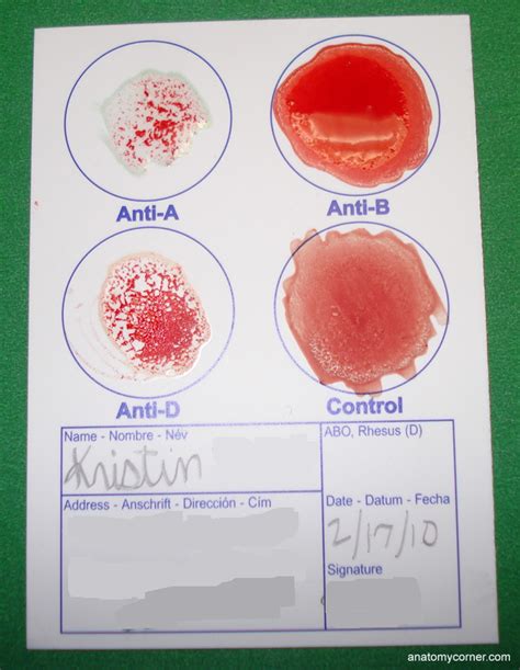 Shows how blood typing is done using an eldoncard. Blood Type Analysis